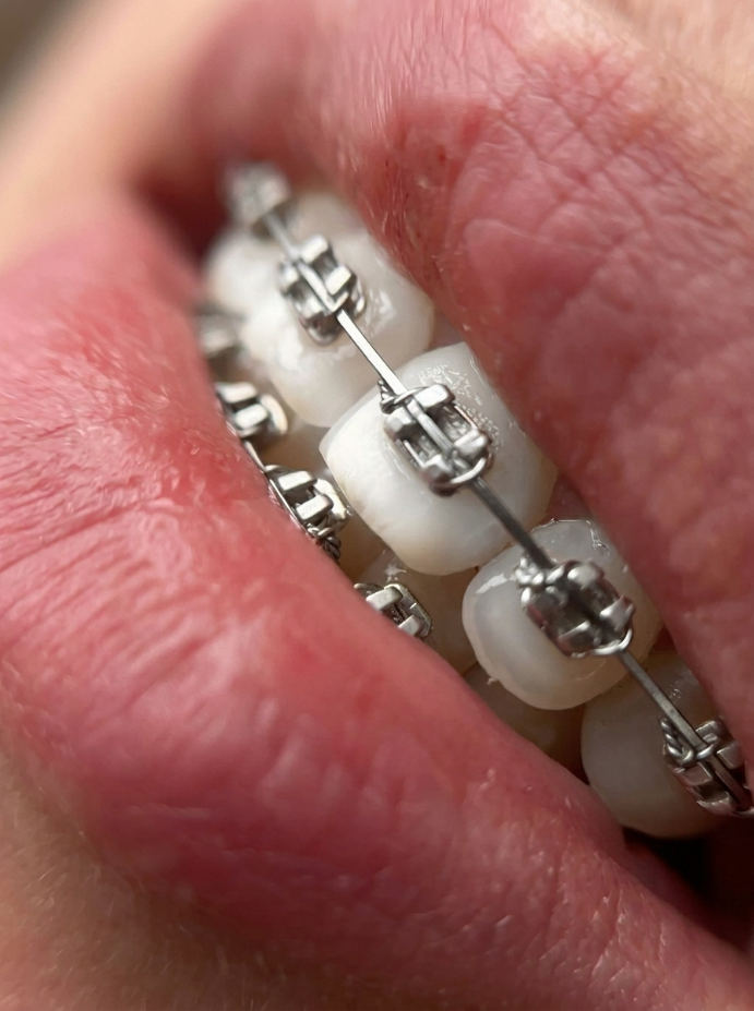 Metal (Traditional) Braces